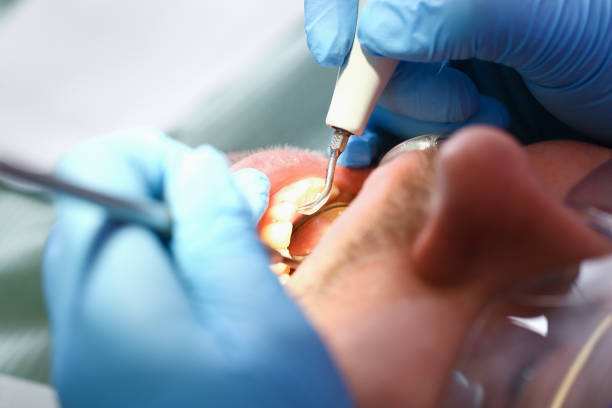 Best Emergency Dental Care for Broken or Chipped Teeth in Grayslake, IL